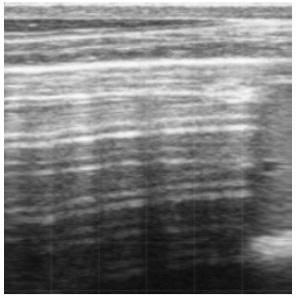 An ultrasound showing healthy, aerated lungs. 